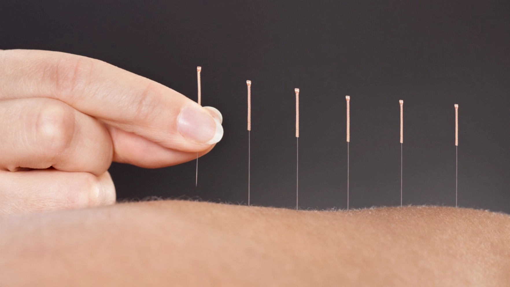 What is Acupuncture? Its Health Benefits, and more