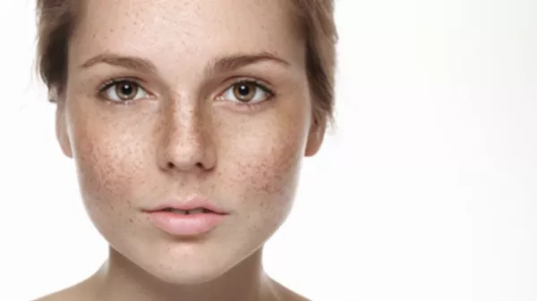 Hyperpigmentation