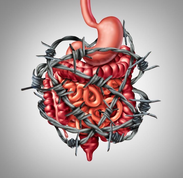 Irritable bowel syndrome (IBS)