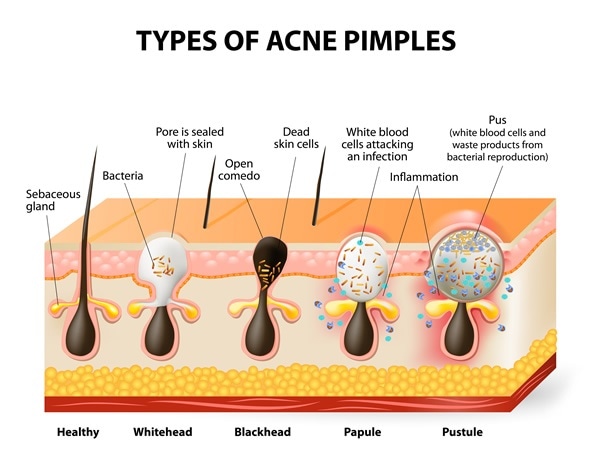 Different Types Of Acne