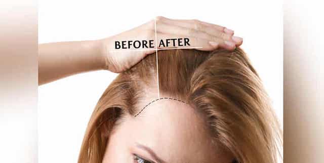 Is hair transplant a long-term solution?